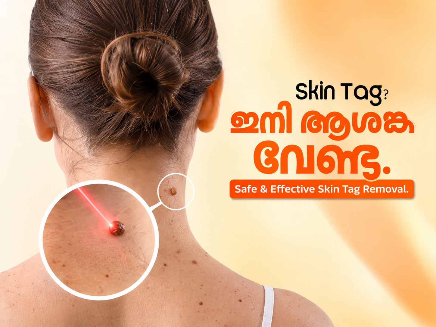 Skin Tag, Wart & Mole Removal